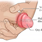 Paraphimosis - bán hẹp bao quy đầu