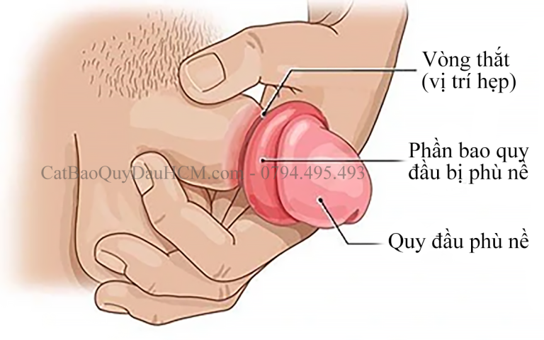 Paraphimosis – Cấp cứu nam khoa cần biết ngay