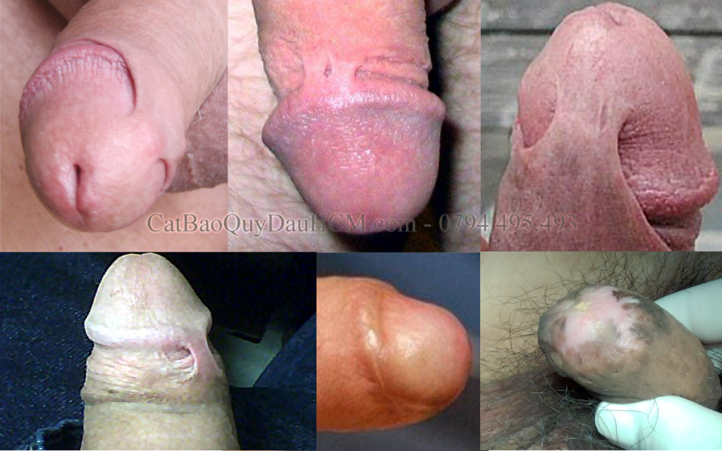 Dính bao quy đầu