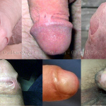 Dính bao quy đầu