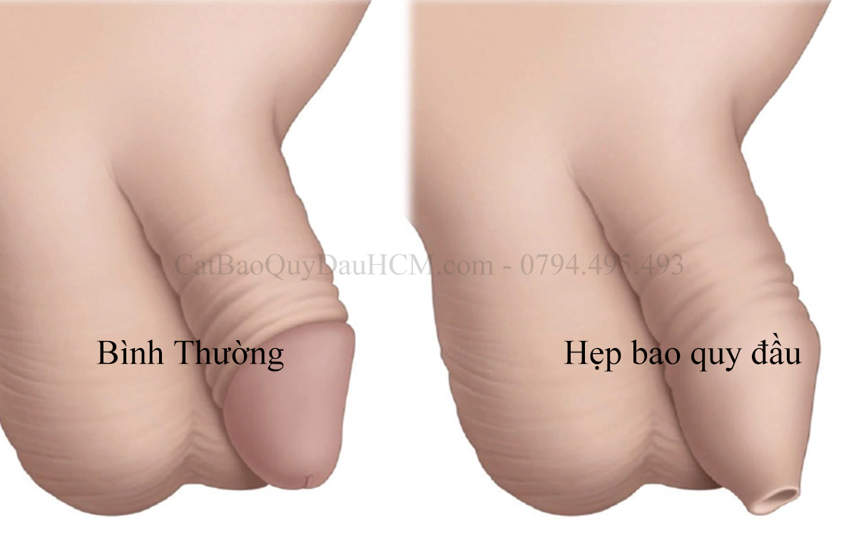 phimosis