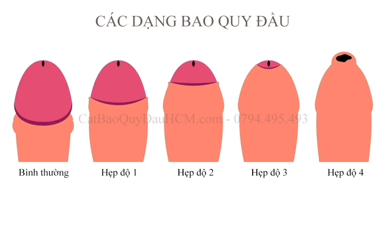 Hẹp bao quy đầu là gì? Phân độ và dấu hiệu nhận biết