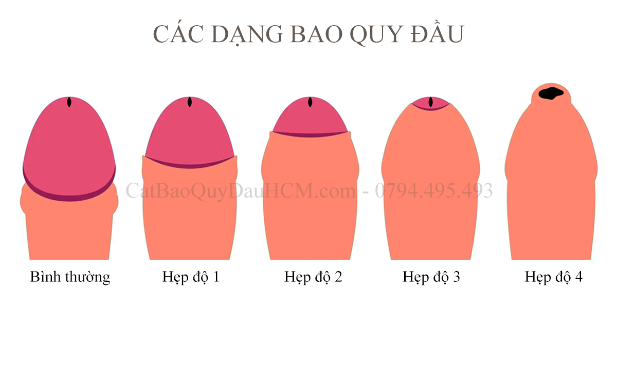 hẹp bao quy đầu