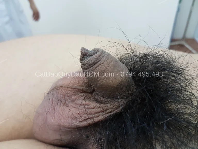 Bệnh Lý Bao Quy Đầu: Hướng Dẫn Toàn Diện Từ Bác Sĩ