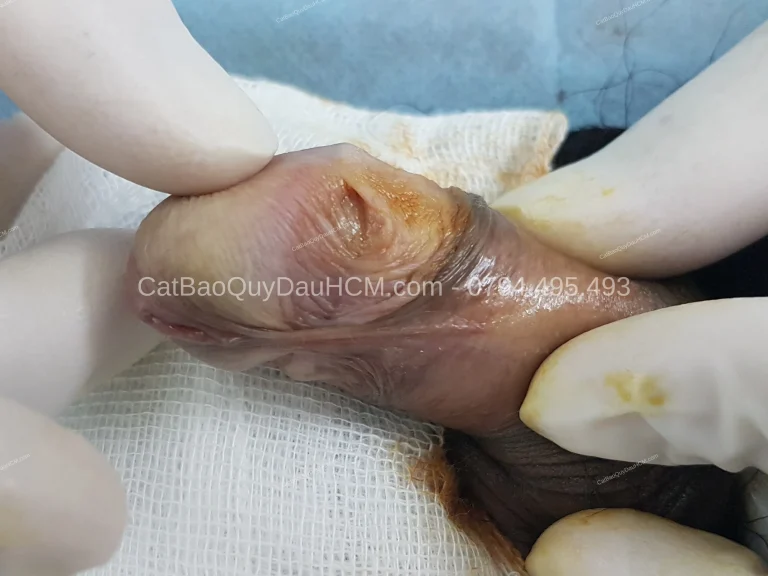Cắt bao quy đầu ở đâu TP.HCM? Tiêu chí chọn nơi làm